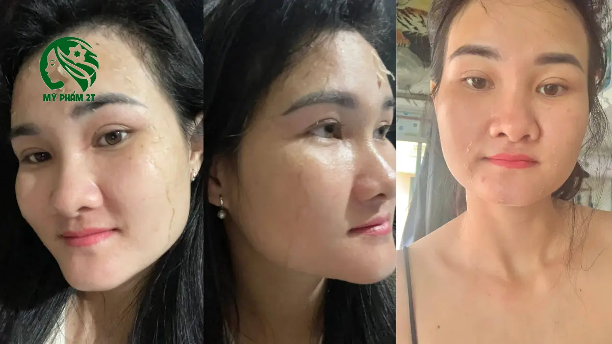 Các loại peel da tốt nhất hiện nay an toàn cho spa và chăm sóc da tại nhà