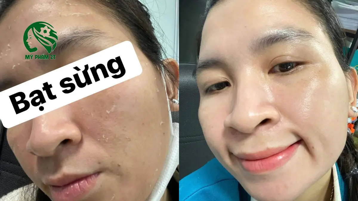 Các loại peel da tốt nhất hiện nay giúp tái tạo da sáng khỏe