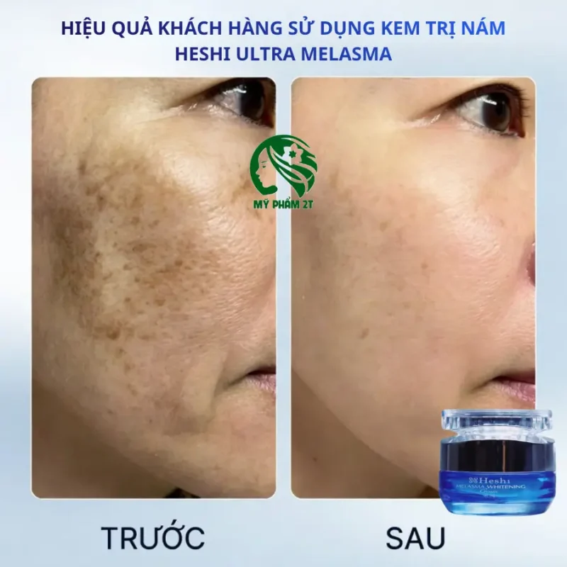 Top 5 Kem Nám Hiệu Quả Được Bán Chạy Nhất Tại Mỹ Phẩm 2T 5 Hiệu Quả Khách Hàng Sử Dụng Kem Trị Nám Ultra Melasma Heshi