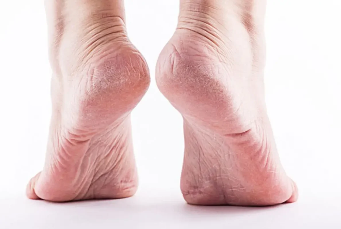 Gót Chân Bị Khô, Nứt Nẻ