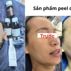 Sản Phẩm Peel Da Trị Nám Tốt Nhất Hiện Nay – Cách Chọn An Toàn Và Hiệu Quả