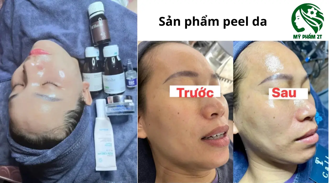 Sản Phẩm Peel Da Trị Nám Tốt Nhất Hiện Nay – Cách Chọn An Toàn Và Hiệu Quả
