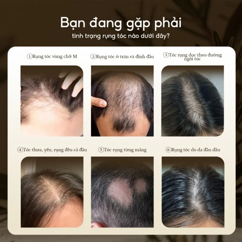Xịt Mọc Tóc Lab On Hair 160Ml Giấm Táo – Kích Thích Mọc Tóc, Giảm Rụng Hiệu Quả 13 Các Tình Trạng Rụng Tóc Phổ Biến Mà Xịt Mọc Tóc Lab On Hair Hỗ Trợ Cải Thiện