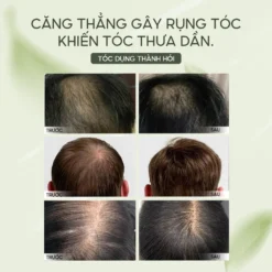 Trước Và Sau Khi Dùng Xịt Mọc Tóc Lab On Hair – Tóc Thưa Được Cải Thiện Rõ Rệt