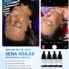 Kết quả trước sau dùng tinh chất sáng da TS f95 Brightening - Mờ thâm nám rõ rệt sau liệu trình