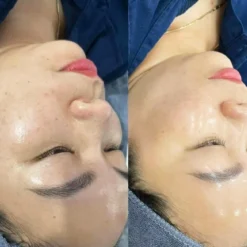 Before After Meso Kim Tảo Heshi – Làn Da Căng Bóng Không Đầu Tiêm