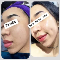 Trước Và Sau Khi Dùng Meso Kim Tảo Heshi – Da Căng Bóng, Sáng Mịn Rõ Rệt