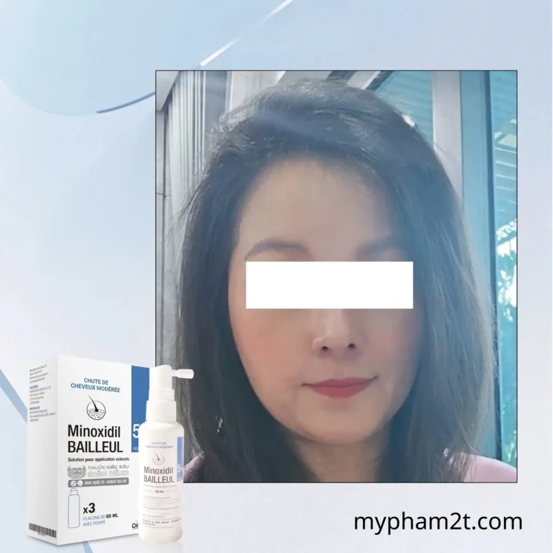 Lưu Ý Khi Dùng Xịt Minoxidil Bailleul 5% Điều Trị Rụng Tóc Hói Đầu