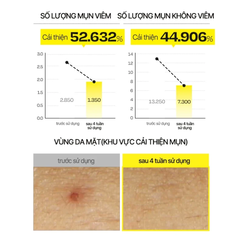 Xịt Khoáng D'Alba First Spray Serum Có Dùng Được Cho Da Mụn Không