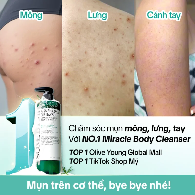 Chăm Sóc Trị Mụn Mông, Lưng, Tay