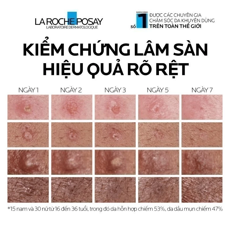 Review Kem Giảm Mụn La RochePosay Effaclar Duo+M Có Tốt Không? 5 Bảng Kiểm Chứng Lâm Sàng Hiệu Quả Giảm Mụn Của La RochePosay Effaclar Duo+M Sau 7 Ngày