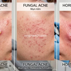 Phân Biệt Mụn Nội Tiết, Mụn Vi Nấm, Mụn Vi Khuẩn, Thiết Kế Liệu Trình Điều Trị Mụn