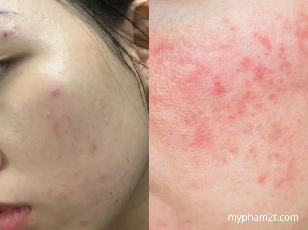 Hướng Dẫn Cách Phân Biệt Da Đang Đẩy Mụn Và Kích Ứng Chuẩn Xác 2 So Sánh Trực Quan Giúp Phân Biệt Da Đang Đẩy Mụn Và Kích Ứng Mỹ Phẩm