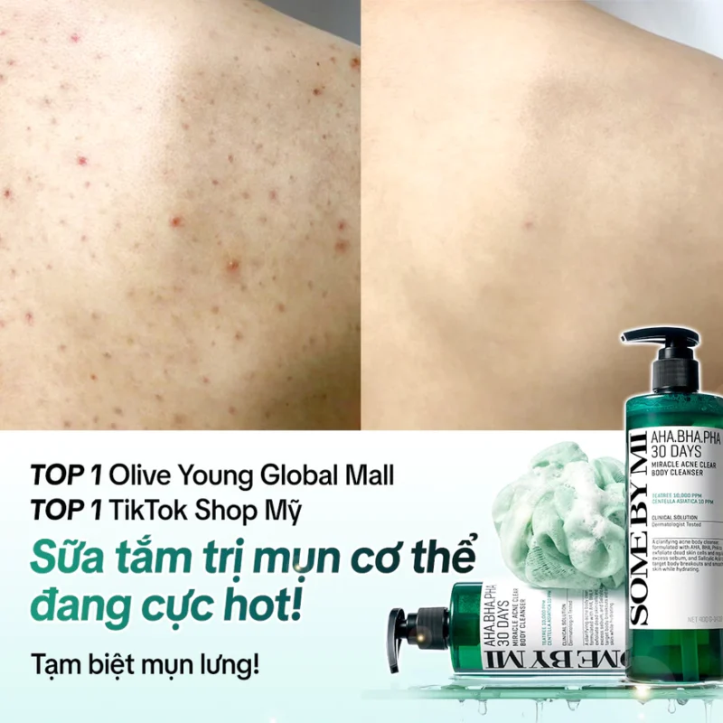 Sữa Tắm Trị Mụn Cơ Thể Somebymi