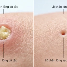 Quy Trình Xông Hơi Và Hút Bã Nhờn Chuẩn Y Khoa Tại Spa